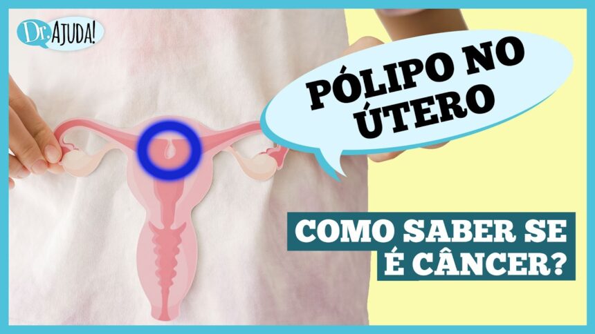 O que são pólipos uterino e quais os sintomas? O que são pólipos uterino e quais os sintomas?