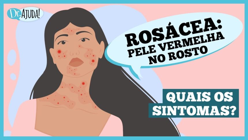 Rosácea: o que é e quais são os sintomas Rosácea: o que é e quais são os sintomas