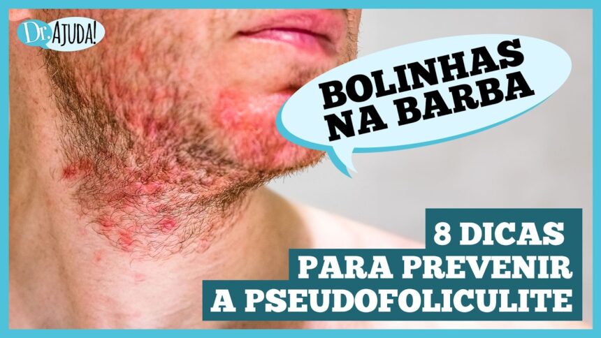 Pseudofoliculite: saiba como prevenir Pseudofoliculite: saiba como prevenir