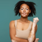 Entenda as causas e os tratamentos para o vitiligo