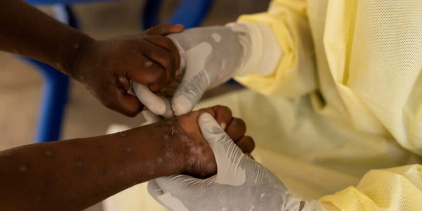 Brasil registra 88 casos de Mpox em 2026; saiba como evitar a doença Brasil registra 88 casos de Mpox em 2026; saiba como evitar a doença