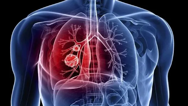 Ceap-Sol alerta para importância do diagnóstico precoce no combate à tuberculose Ceap-Sol alerta para importância do diagnóstico precoce no combate à tuberculose